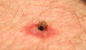 Image of a tick that has transmitted Lyme Disease